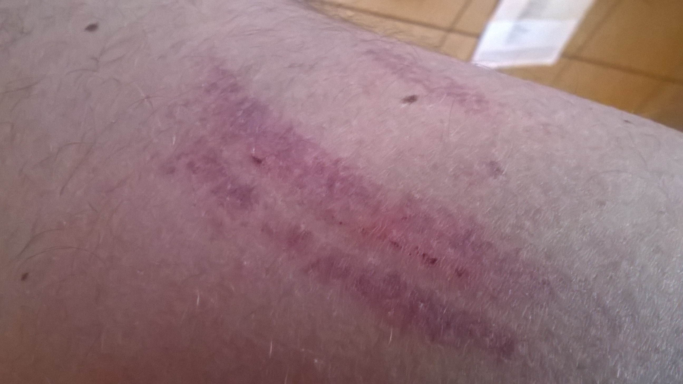 rappage de cuisse